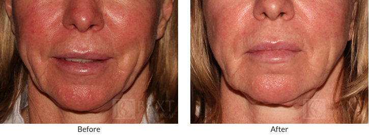 Rosacea Treatment 2