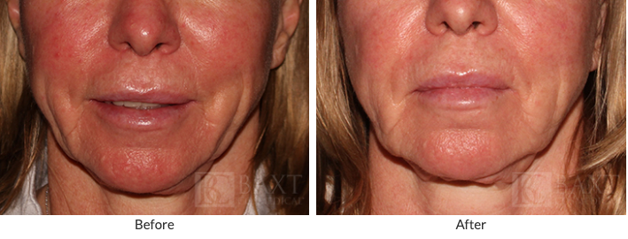 See the Results of Our Rosacea Treatment