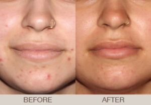 Acne Treatment Gallery