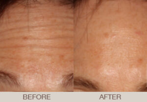 BOTOX<sup>®</sup> Cosmetic Gallery
