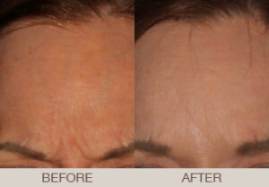 BOTOX<sup>®</sup> Cosmetic Gallery