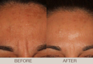 BOTOX<sup>®</sup> Cosmetic Gallery