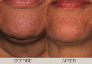 BOTOX<sup>®</sup> Cosmetic Gallery