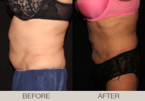 CoolSculpting® Gallery