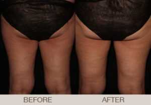 CoolSculpting® Gallery