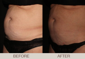 CoolSculpting® Gallery