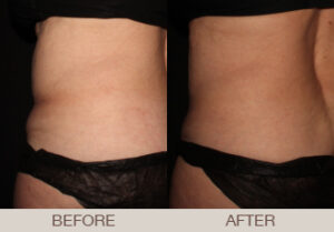 CoolSculpting® Gallery