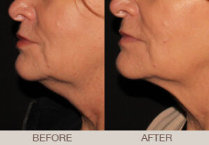 CoolSculpting® Gallery