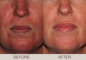 Rosacea Treatment Gallery