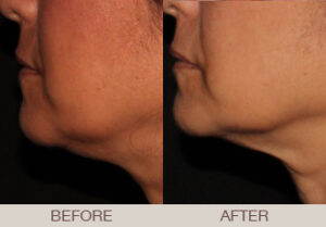 Ultherapy® Gallery