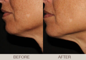 Ultherapy® Gallery