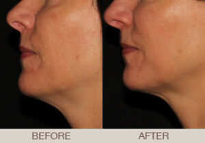 Ultherapy® Gallery