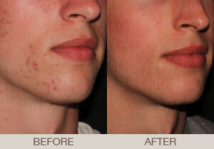 Acne Treatment Gallery
