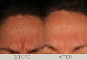 BOTOX<sup>®</sup> Cosmetic Gallery