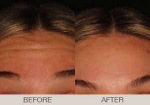BOTOX<sup>®</sup> Cosmetic Gallery