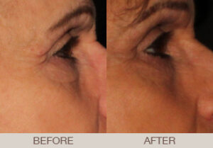 Ultherapy® Gallery