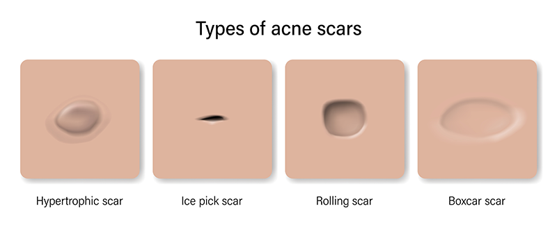 Acne Scars