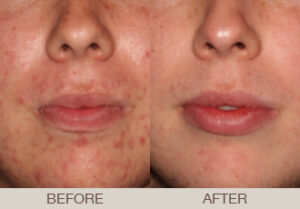 Acne Treatment Gallery