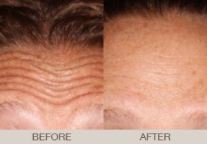 BOTOX<sup>®</sup> Cosmetic Gallery