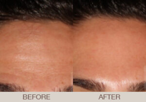 BOTOX<sup>®</sup> Cosmetic Gallery