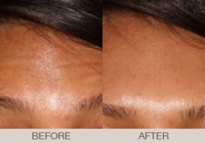 BOTOX<sup>®</sup> Cosmetic Gallery