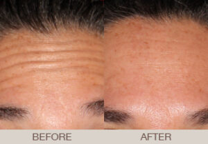 BOTOX<sup>®</sup> Cosmetic Gallery