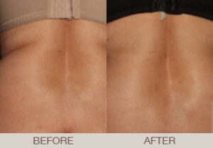 CoolSculpting® Gallery