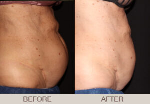 CoolSculpting® Gallery