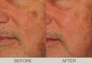 Mole & Lesion Removal Gallery