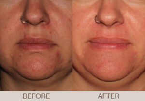 Rosacea Treatment Gallery