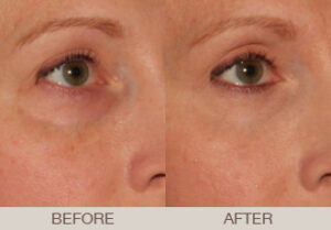 Ultherapy® Gallery
