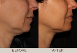 Ultherapy® Gallery