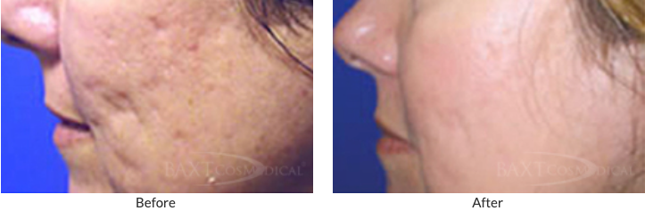 Fraxel Dual Laser Resurfacing Results