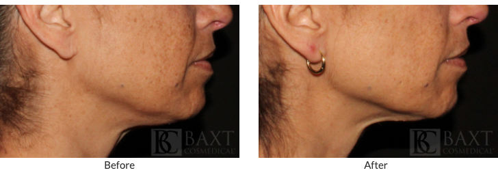 What Treatment Options Are Available To Reverse Sun Damage