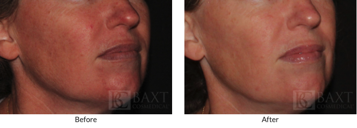 Before-and-After Photofacial Patient Results 2