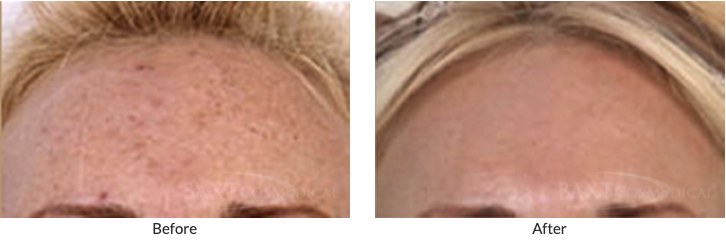 See more Before-and-After Fraxel® Laser Patient Results