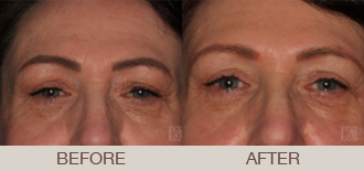 Click Here to View More Ultherapy® Before & After Photos