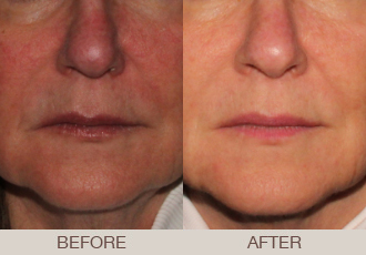 Before & After Photofacial - Paramus NJ Before & After Photofacial - Paramus NJ