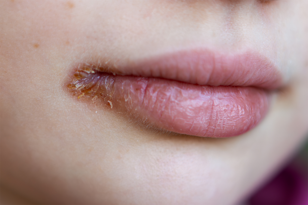 Who is Most Likely to Develop Lip Inflammation