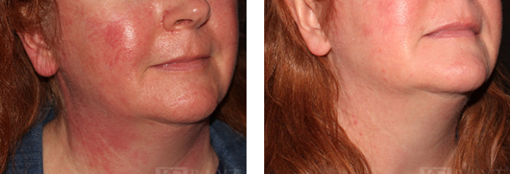 BAXT CosMedical® Rosacea Patient Results