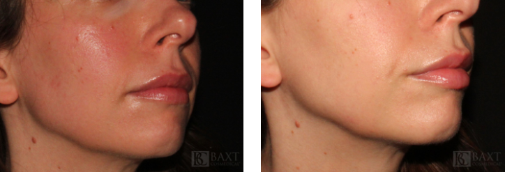 BAXT CosMedical® Rosacea Patient Results