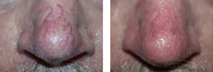 BAXT CosMedical® Rosacea Patient Results
