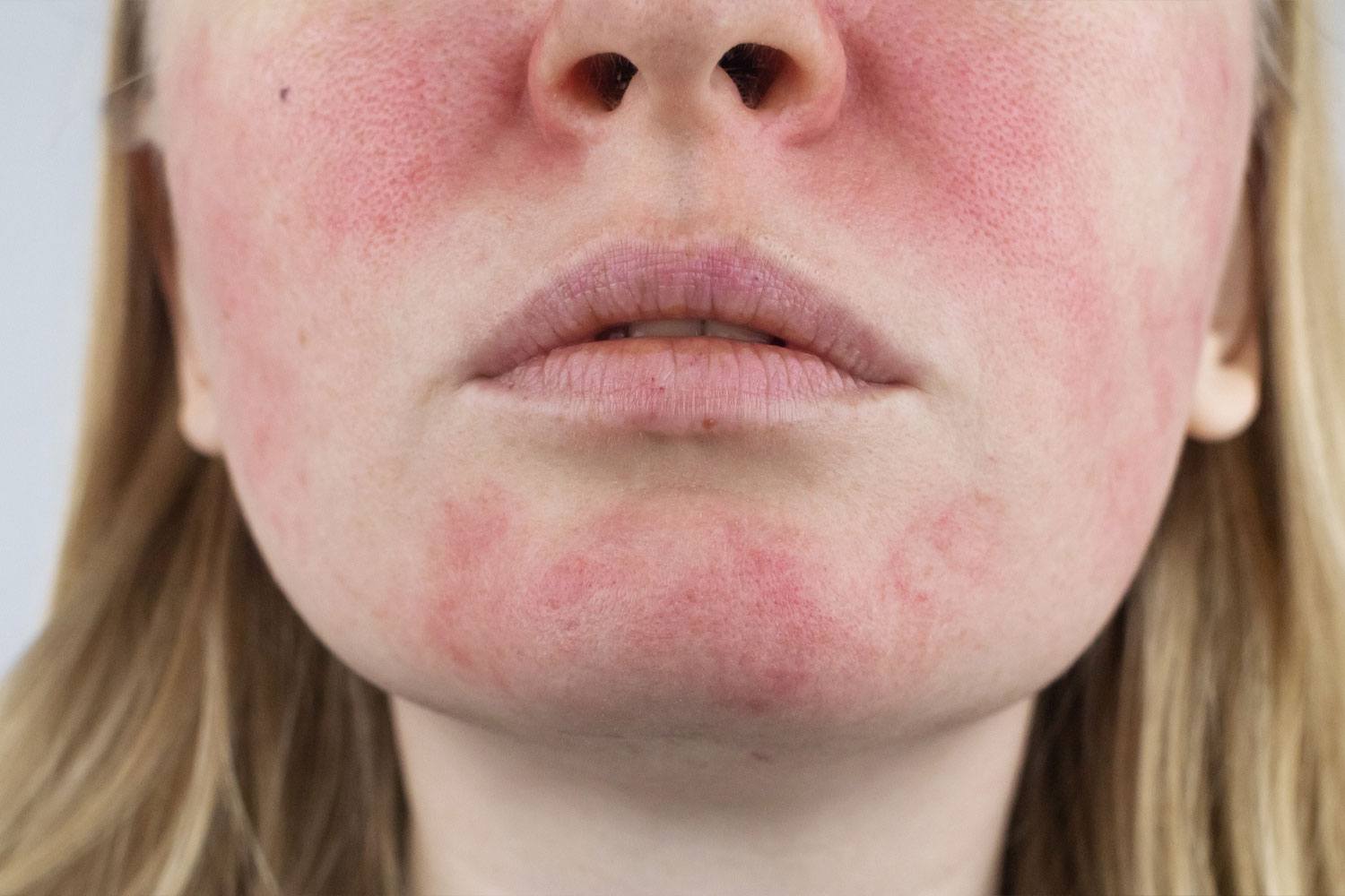 Spotlight on Rosacea…Rosacea Awareness Month