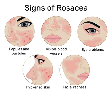 What is Rosacea?