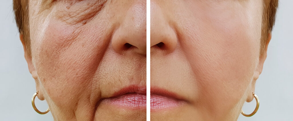 Weight Loss Drugs and the Effects on Your Skin and Hair