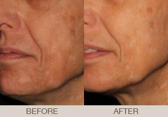 Chemical Peels Before and After | Paramus, NJ Chemical Peels Before and After | Paramus, NJ