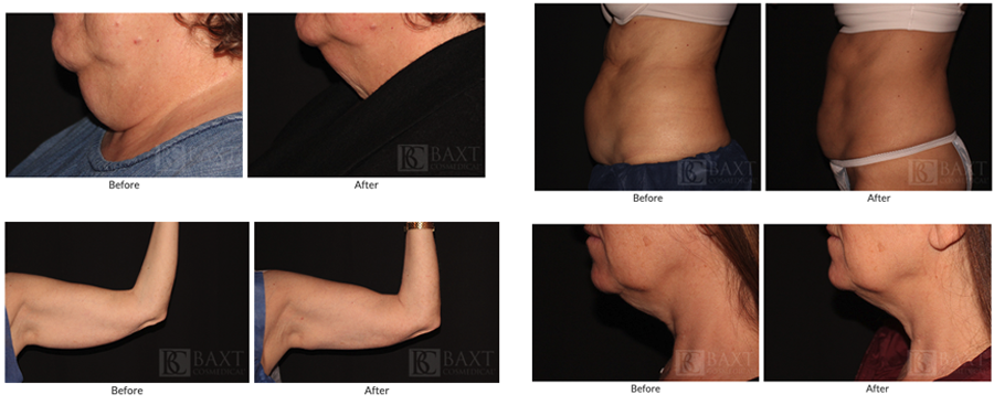 CoolSculpting®
Results