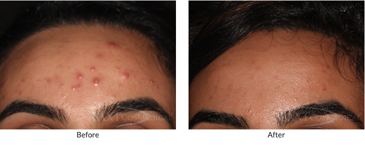 Dr. Baxt Before and After Chemical Peel for acne and acne scars. Patient Results #64 Dr. Baxt Before and After Chemical Peel for acne and acne scars. Patient Results #64