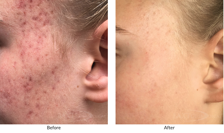 Dr. Baxt Before and After Chemical Peel for acne and acne scars. Patient Results #16 Dr. Baxt Before and After Chemical Peel for acne and acne scars. Patient Results #16