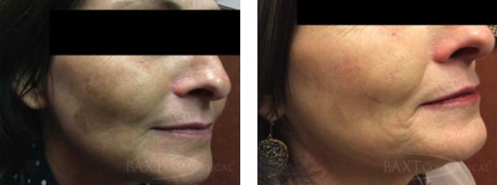 See More Before/After Chemical Peel Patients Before/After Chemical Peel Patient Results #2